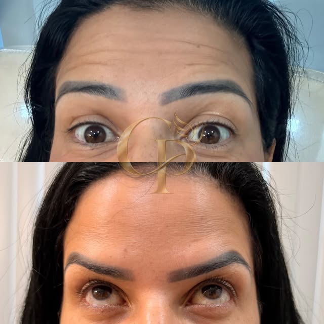 Antes e depois de toxina botulínica na testa: em cima com rugas, embaixo lisa.