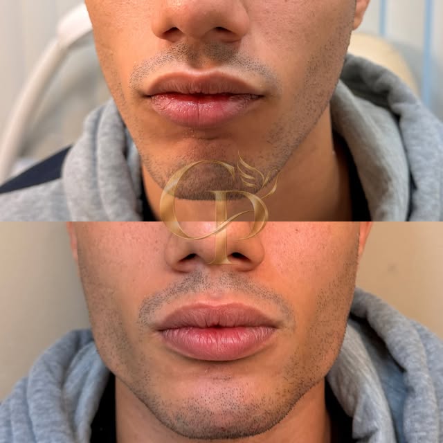 Antes e depois masculino da região da boca e mandíbula: embaixo, contorno mais definido.