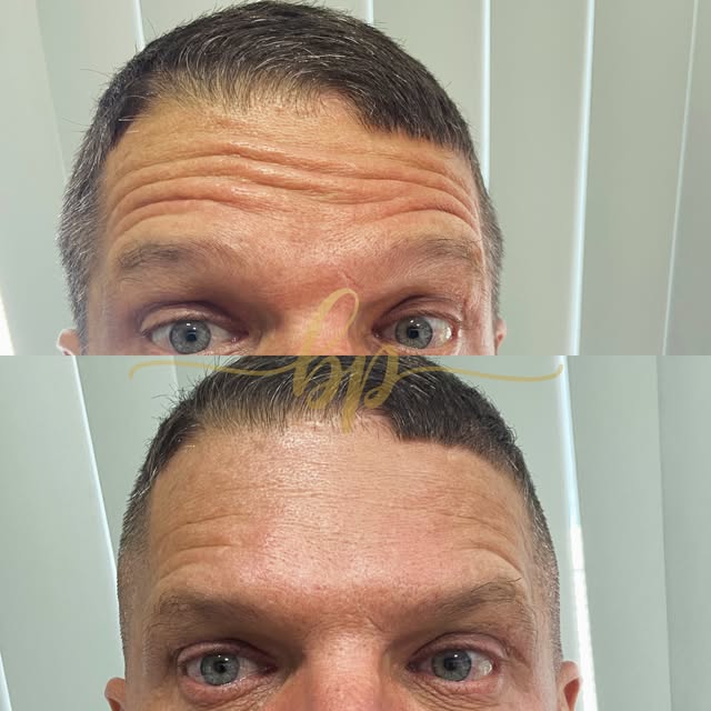 Antes e depois masculino: em cima, testa com linhas marcadas; embaixo, testa lisa.