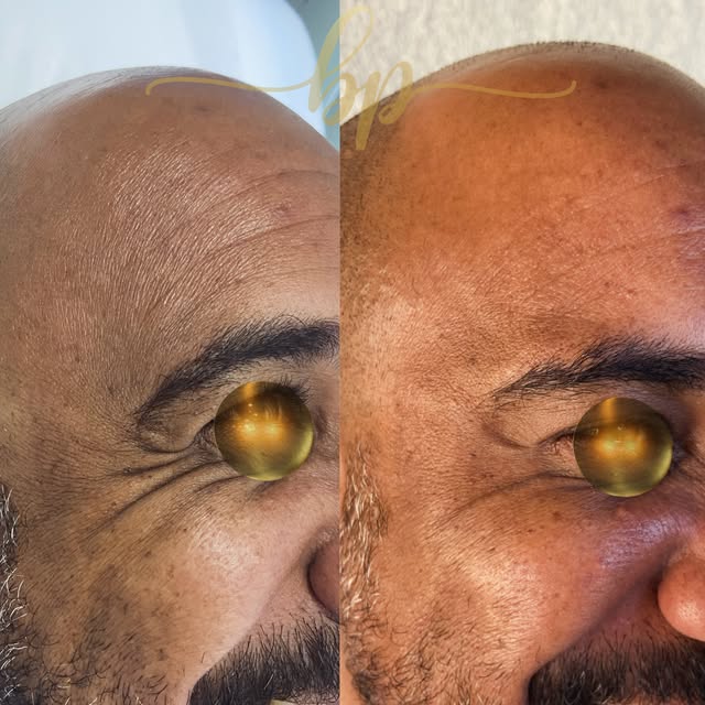 Antes e depois masculino da região dos olhos, com os olhos cobertos: à direita, pés de galinha suavizados.