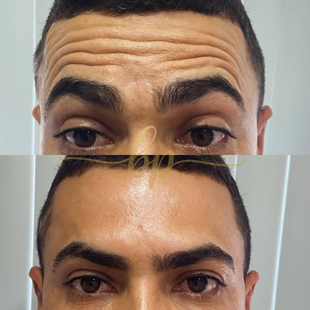 Antes e depois masculino: em cima, testa franzida com linhas; embaixo, testa lisa e sobrancelhas relaxadas.