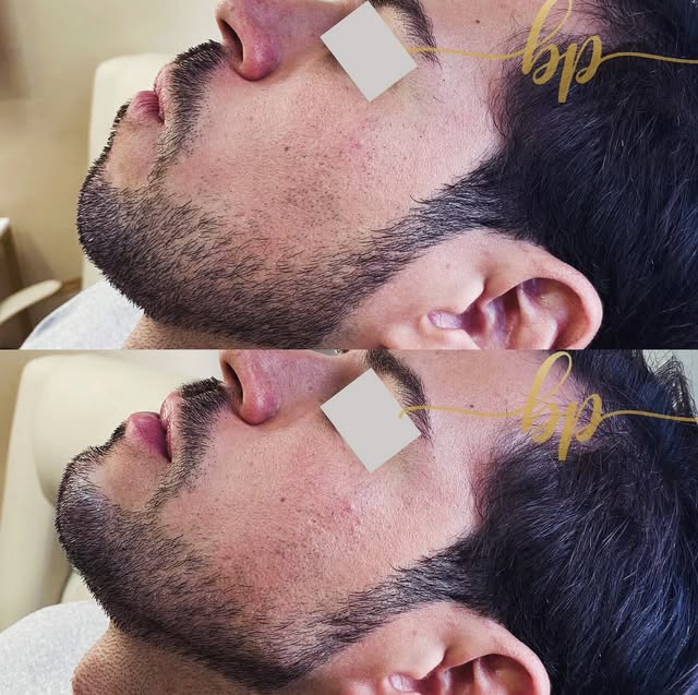 Antes e depois de mandíbula e mento, de perfil: embaixo, queixo e mandíbula mais projetados.