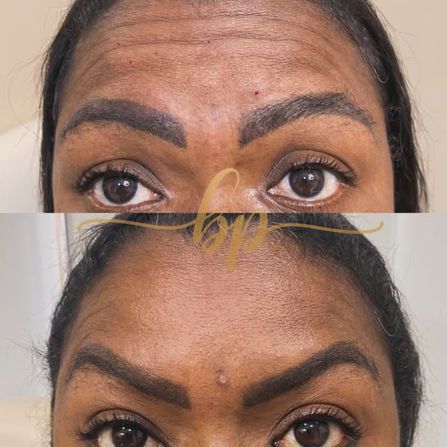 Antes e depois de toxina botulínica: embaixo, testa lisa e olhar elevado.