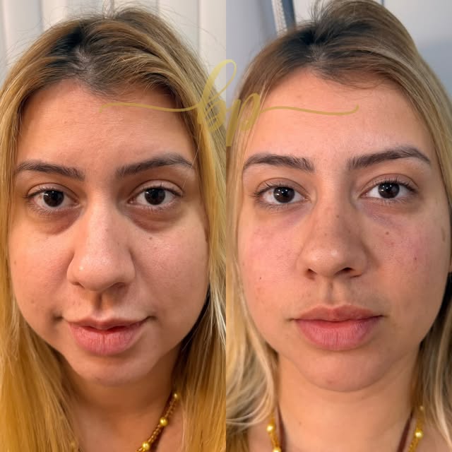 Antes e depois de preenchimento de olheiras: à esquerda olheiras fundas, à direita olhar descansado.