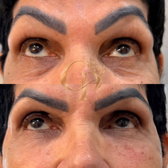 Antes e depois de preenchimento de olheiras em pele madura: embaixo, região dos olhos mais lisa.