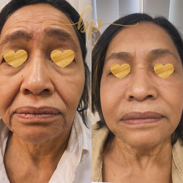 Antes e depois de rejuvenescimento facial em mulher madura, com os olhos cobertos: à direita sulcos e rugas suavizados.